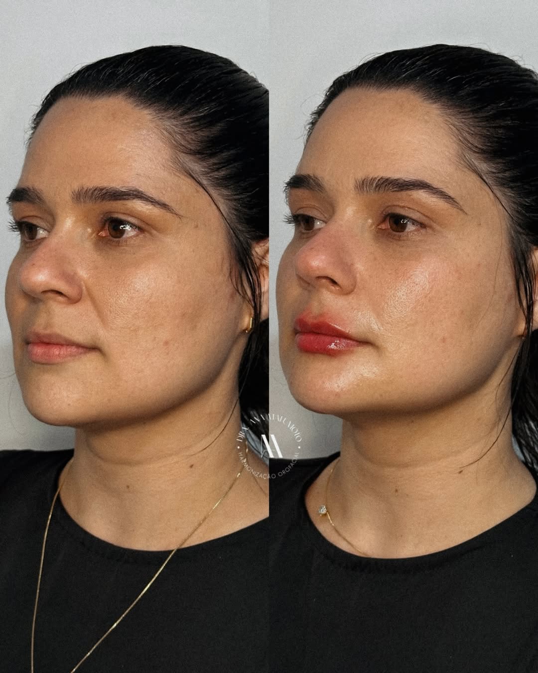 Antes e depois — caso 3